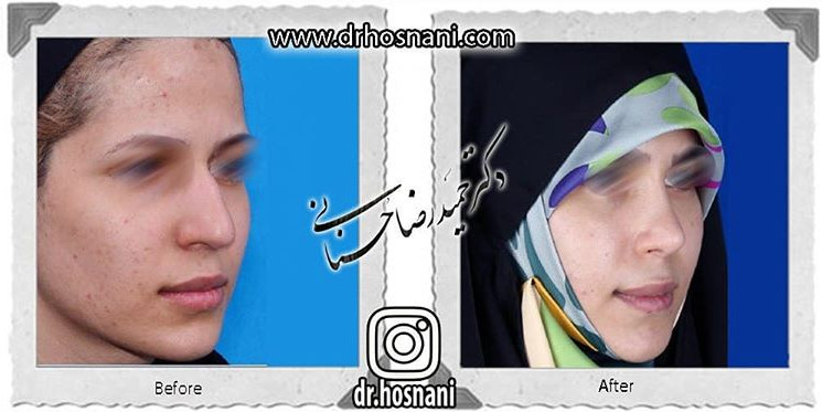  جراحی بینی -776