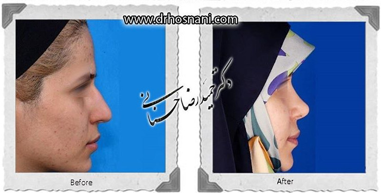  جراحی بینی -777