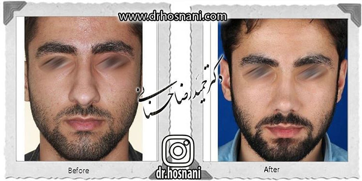  جراحی بینی -778