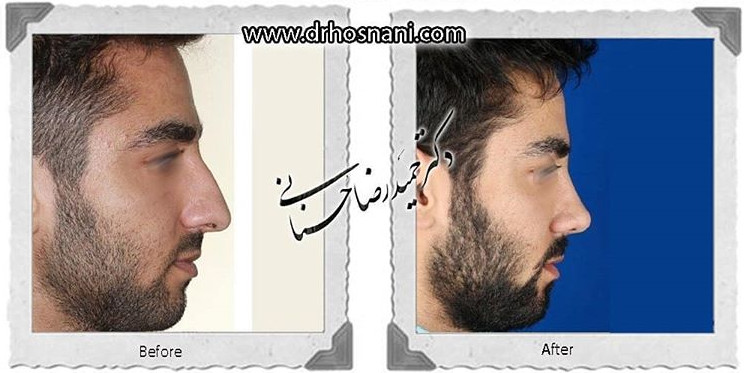  جراحی بینی -779