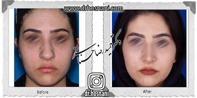 اصلاح انحراف بینی