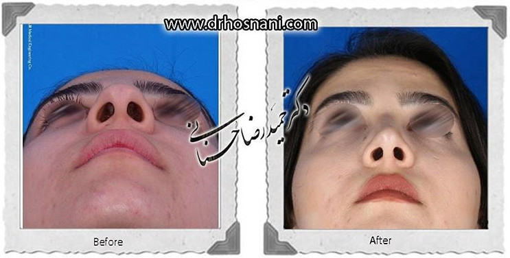 اصلاح انحراف بینی
