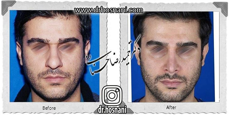  جراحی بینی -782