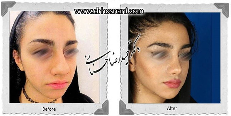  جراحی بینی -785