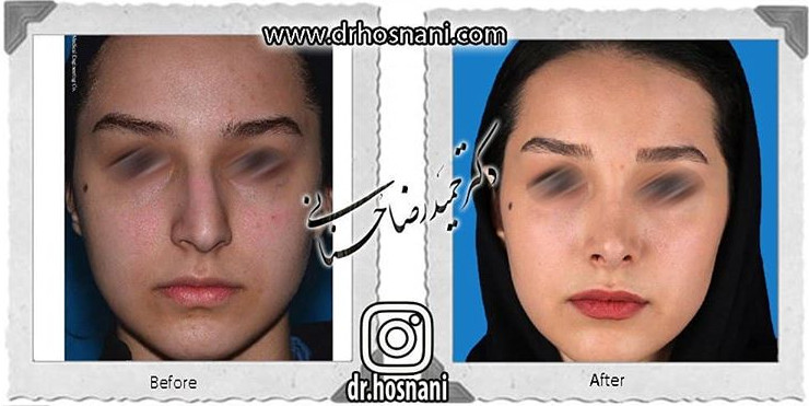اصلاح انحراف بینی