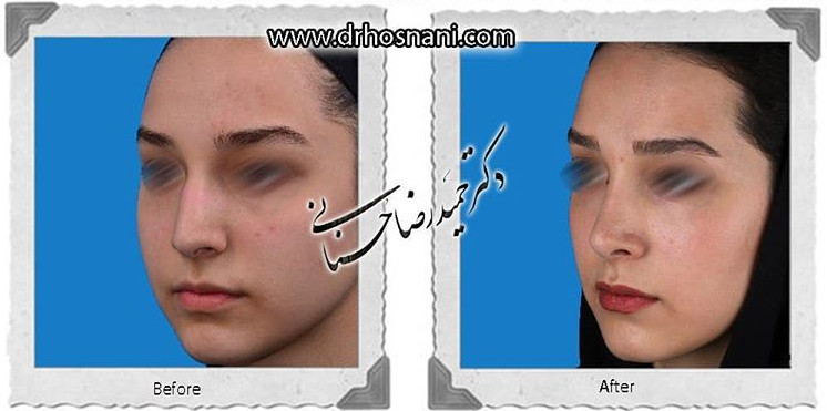اصلاح انحراف بینی
