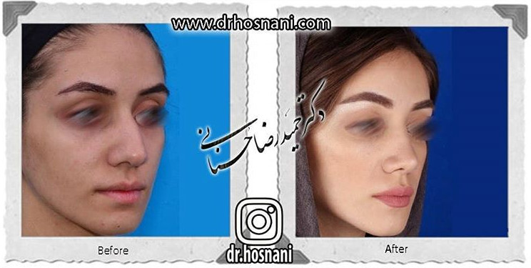  جراحی بینی -788