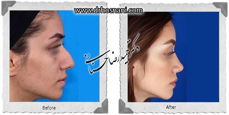  جراحی بینی -789