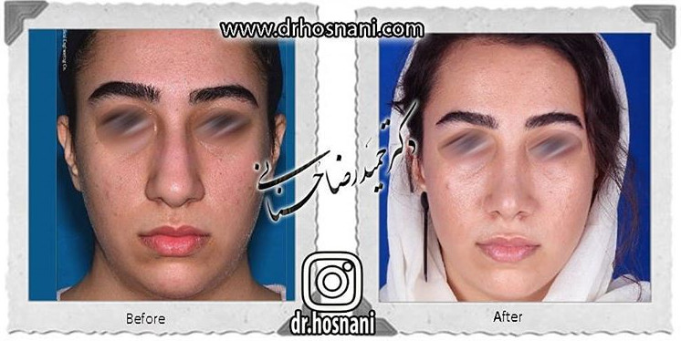  جراحی بینی -790