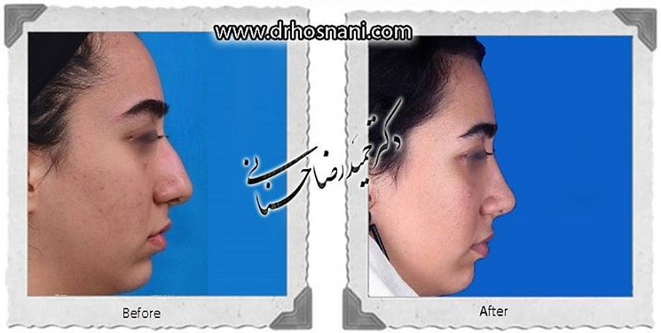  جراحی بینی -791