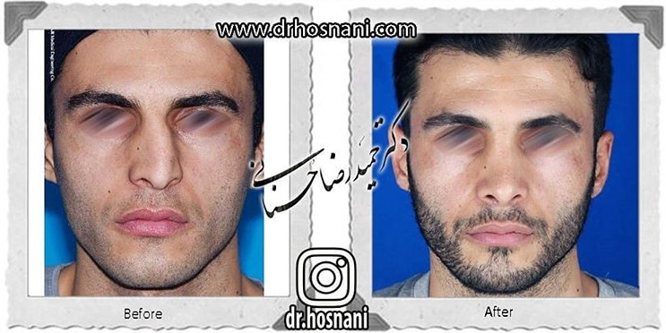 اصلاح انحراف بینی