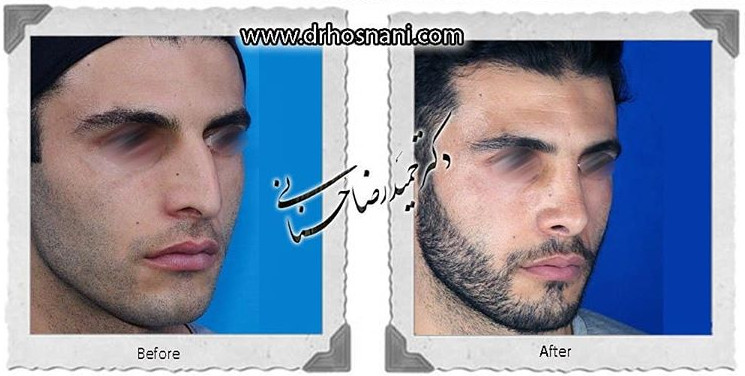 اصلاح انحراف بینی