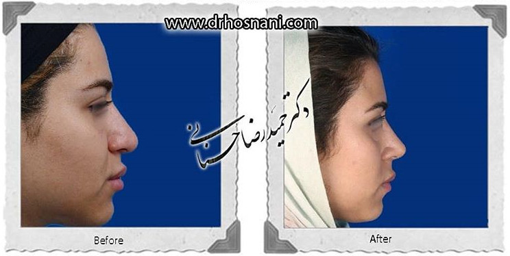  جراحی بینی -795