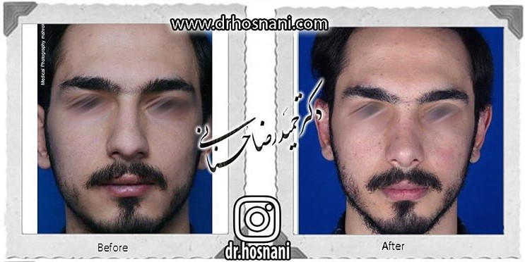  جراحی بینی -796