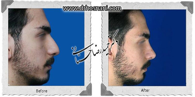  جراحی بینی -797