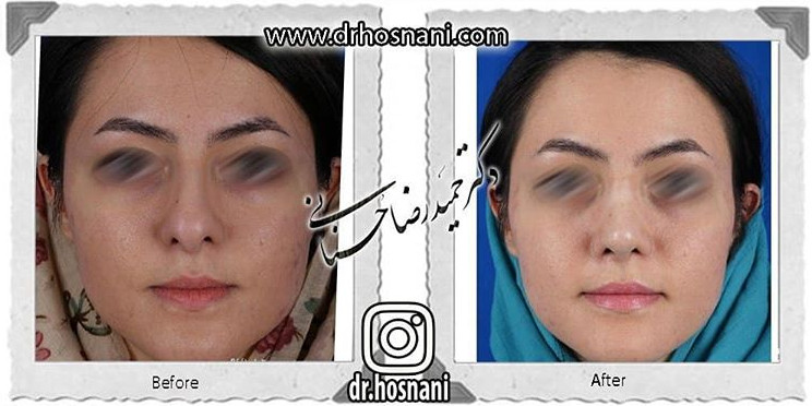  جراحی بینی -798