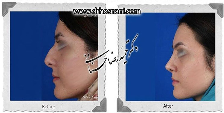  جراحی بینی -799