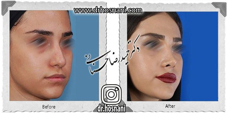  جراحی بینی -800