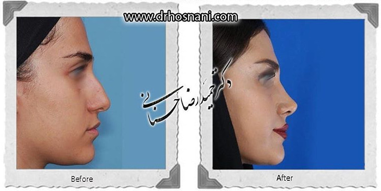  جراحی بینی -801