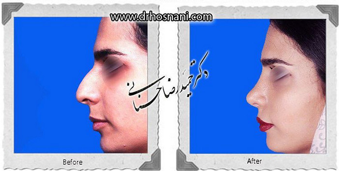  جراحی بینی -807