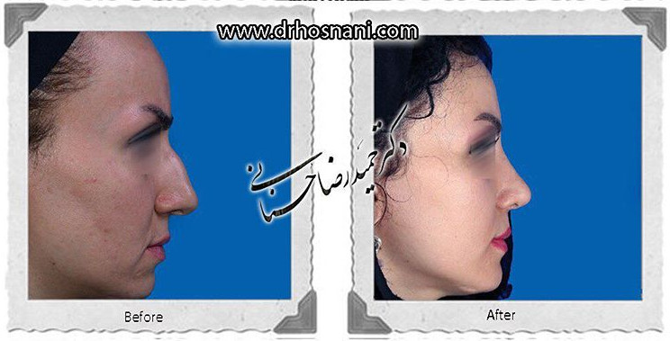  جراحی بینی -809