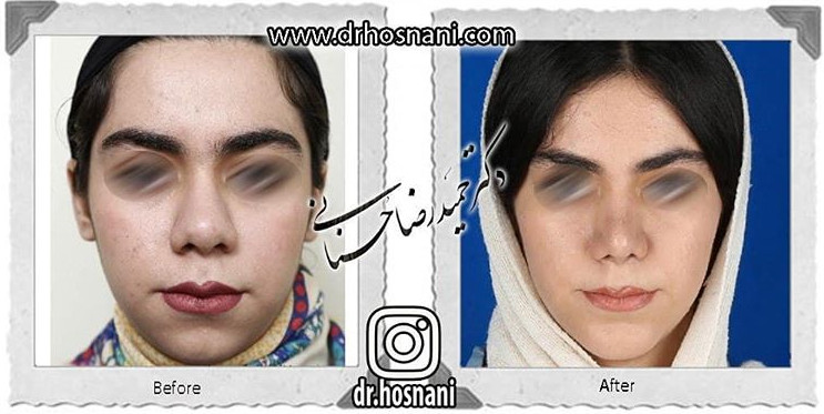  جراحی بینی -810