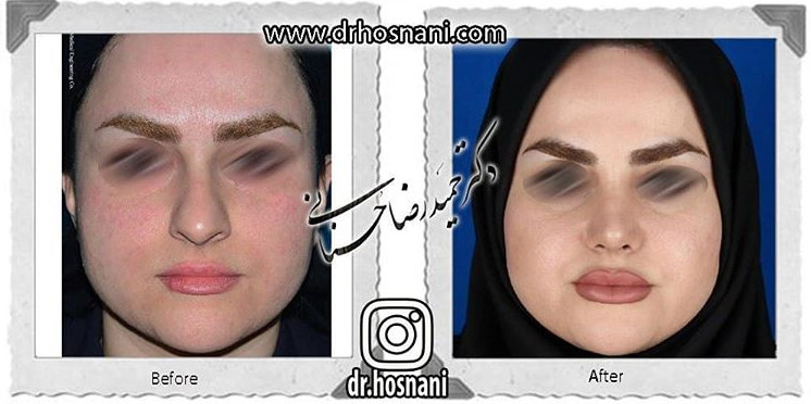  جراحی بینی -812