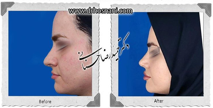  جراحی بینی -813