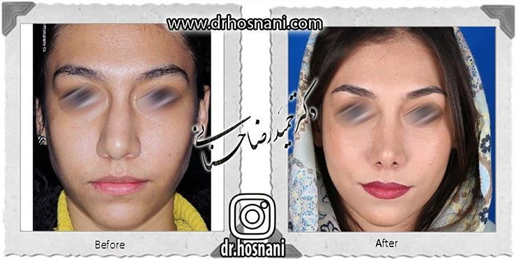 اصلاح انحراف بینی
