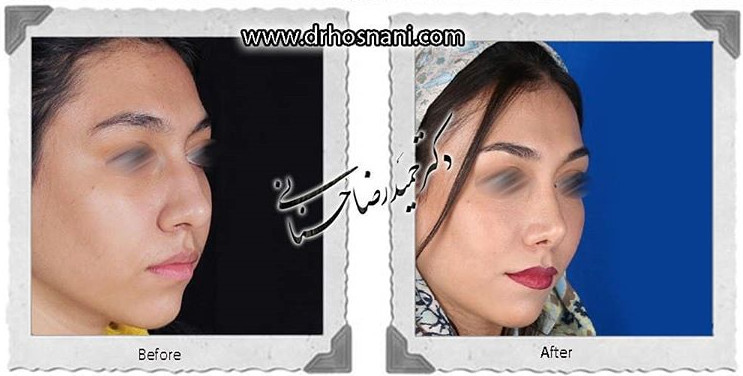 اصلاح انحراف بینی