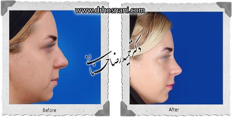  جراحی بینی -817