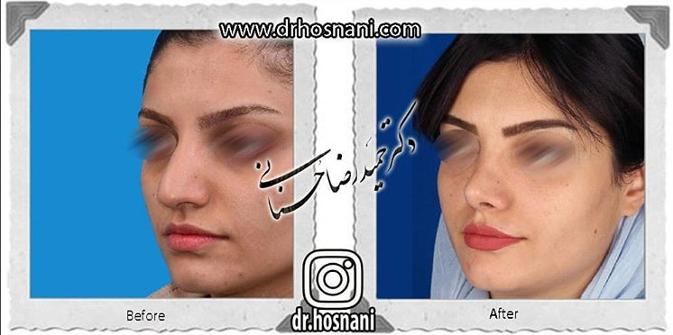  جراحی بینی -818