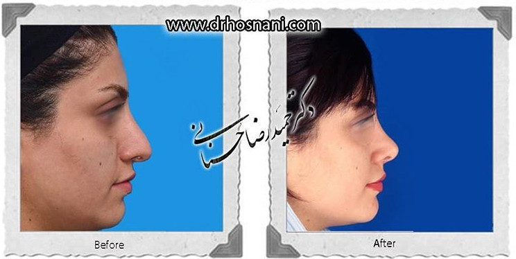  جراحی بینی -819