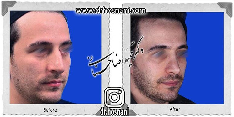  جراحی بینی -820