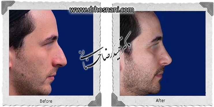  جراحی بینی -821