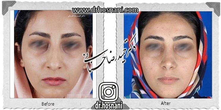  جراحی بینی -822