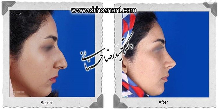 جراحی بینی -823