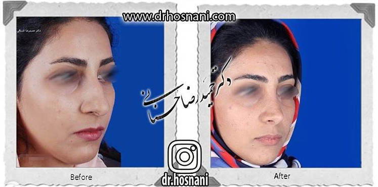  جراحی بینی -824