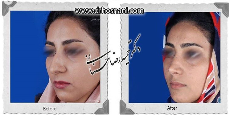  جراحی بینی -825