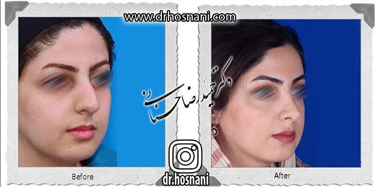  جراحی بینی -826