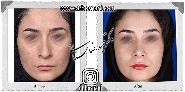  جراحی بینی -828