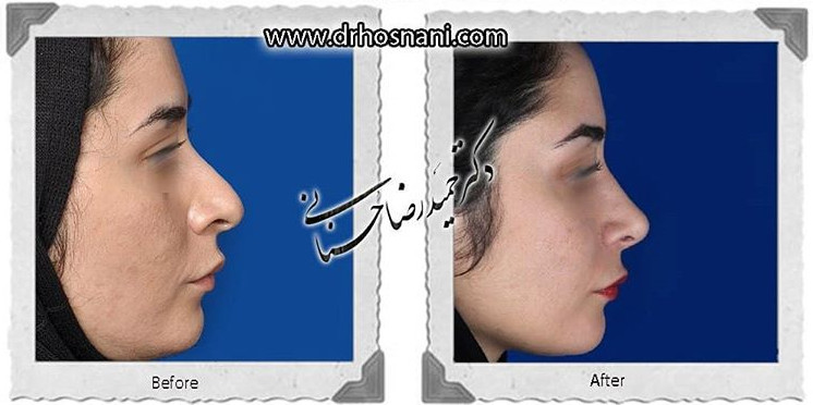  جراحی بینی -829