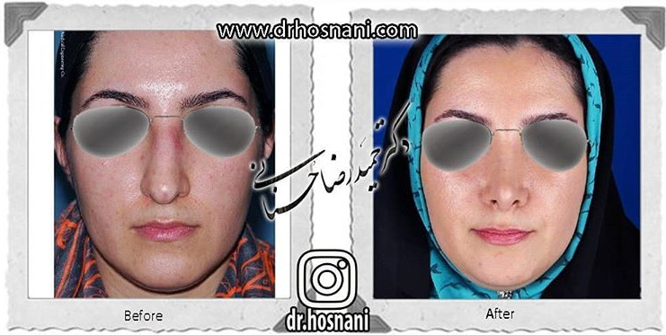 اصلاح انحراف بینی