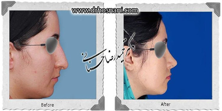 اصلاح انحراف بینی