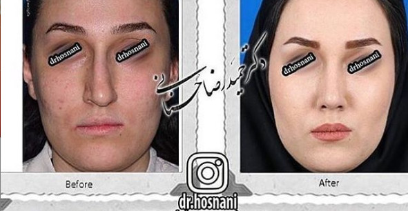 جراحی بینی