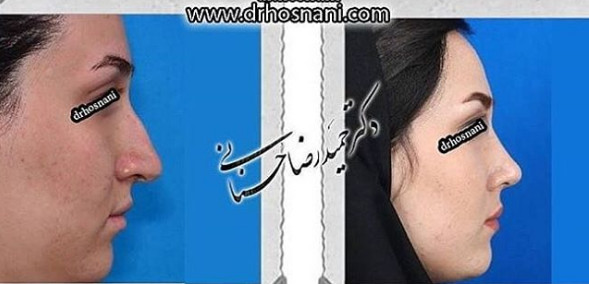 جراحی بینی