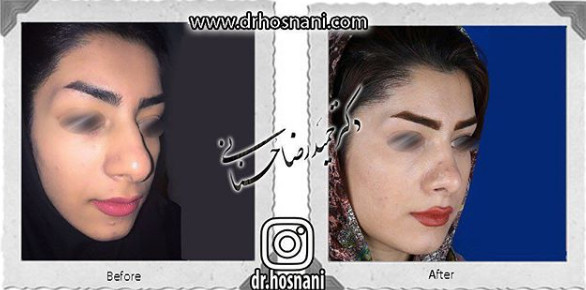  جراحی بینی -834