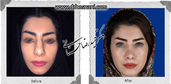  جراحی بینی -835