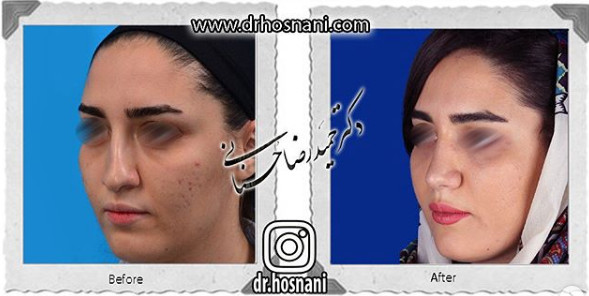 اصلاح انحراف بینی