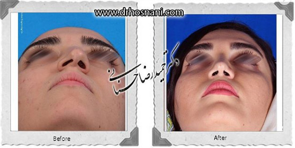 اصلاح انحراف بینی